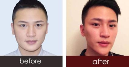 假体隆下巴成好吗