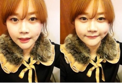 人造酒窝有后遗症