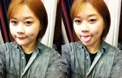 人造酒窝有后遗症