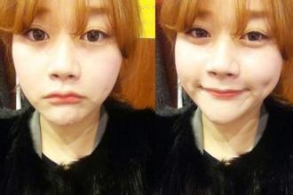 人造酒窝有后遗症