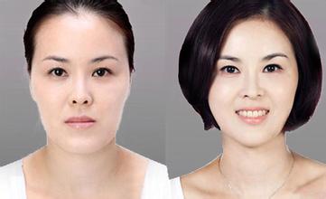 韩式微创改脸型手术价格