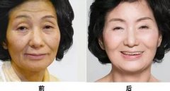 脸部皮肤松弛下垂怎么办 脸部皮肤松弛下垂怎么办