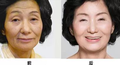 脸部皮肤松弛下垂怎么办