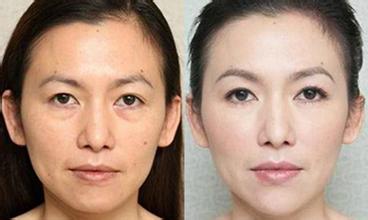 脸部皮肤松弛下垂怎么办