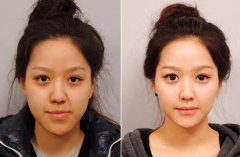 下颌角整形恢复期多久 下颌角整形案例对比照片