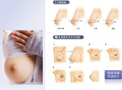 乳房下垂矫正术后可能有后遗症吗