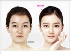 女人尖下颌角整形果怎么样