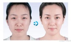 丰太阳穴有什么副作用