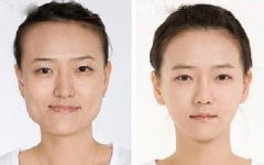 垫下巴注意事项有哪些 垫下巴注意事项有哪些