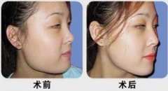 尖下颌角整形介绍