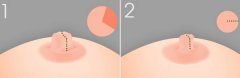 乳头缩小术后两侧能对称吗 乳头缩小术有什么优点