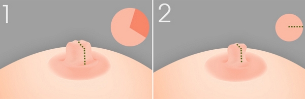 乳头缩小术