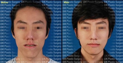 韩国,bk东洋,整形,夏季,大礼包