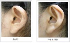 招风耳矫正术后疤痕多久消失 招风耳矫正术后怎么护理
