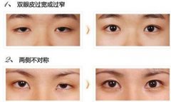 重庆眼部整形美容手术失败修复多少钱