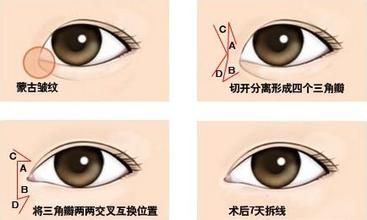 重庆眼部整形美容手术失败修复多少钱