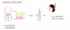 自体脂肪丰面颊有硬块能取出吗