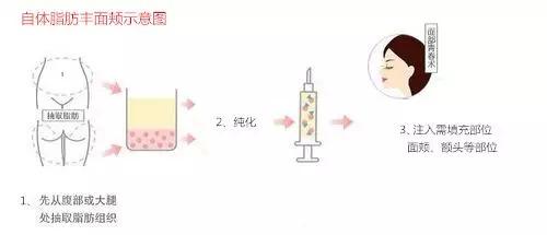 自体脂肪,丰面颊,硬块,取出