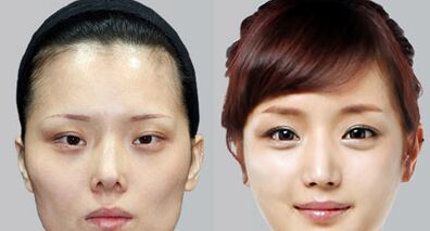 颧骨高整容手术多少钱-三元整形网