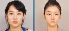 女性尖下颌角整形注意事项