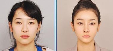女性尖下颌角整形注意事项