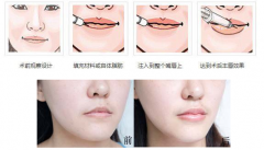 玻尿酸丰唇后嘴唇变肿正常吗 玻尿酸丰唇后嘴唇变肿正常吗