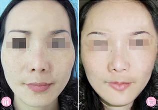 额头太阳穴有点凹陷怎么办?丰太阳穴手术的方法有哪些