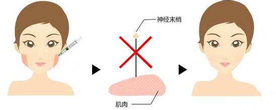 咬肌肥大的原因