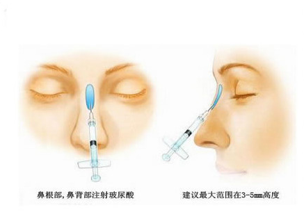 注射,隆鼻,失败