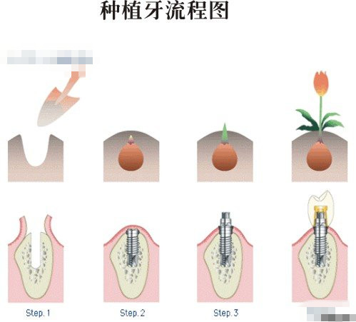 种植牙多少钱一颗