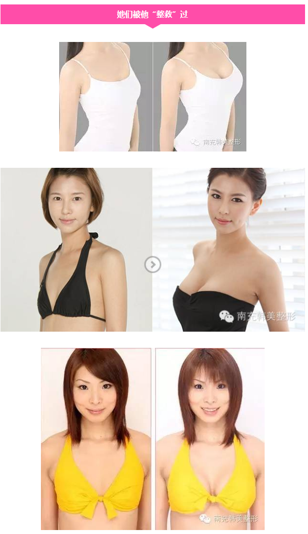 南充韩美整形医院李京自体脂肪隆胸怎么样