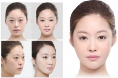 去眼袋失败后修复的方法有哪些 去眼袋失败后修复的方法有哪些