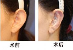 招风耳矫正需要去骨吗 招风耳矫正术前注意事项有哪些 招风耳矫正需要去骨吗 招风耳矫正术前注意事项有哪些