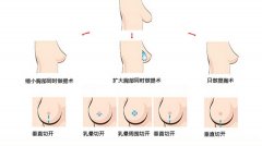 内窥镜乳房下垂矫正切口明X吗