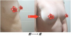 假体隆胸后趴着睡会压爆假体吗