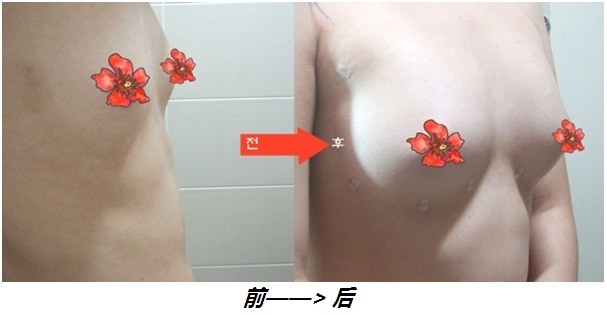 假体,隆胸,压爆