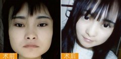 下颌角截骨手术后遗症