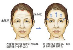 拉皮除皱果好不好? 拉皮除皱果好不好?