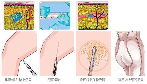吸脂瘦腿流程