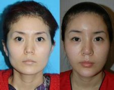 脸上咬肌太大怎么办