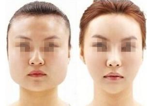 脸上咬肌太大怎么办