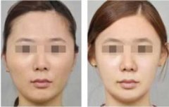 玻尿酸丰太阳穴降低风险吗 玻尿酸丰太阳穴降低风险吗
