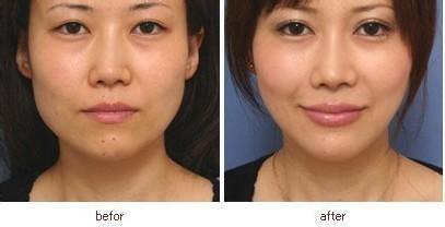 B****去咬肌的果