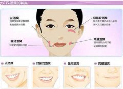 做酒窝术前术后应该注意什么