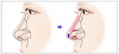 鼻梁塌陷怎么办选择哪种隆鼻方式好?