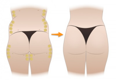 自体脂肪丰臀后皮肤不平整怎么回事