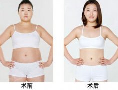 全身抽脂减肥多少钱 抽脂减肥价格一览表