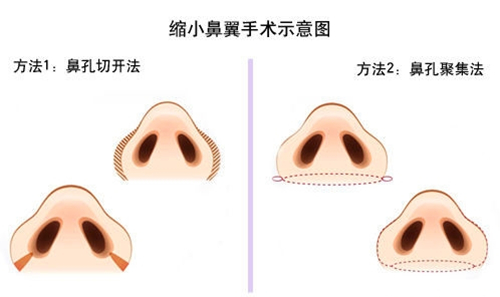 鼻翼缩小手术多少钱