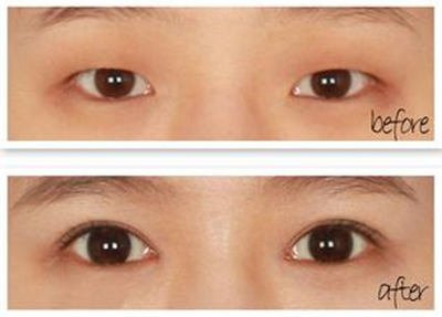 开眼角多少钱