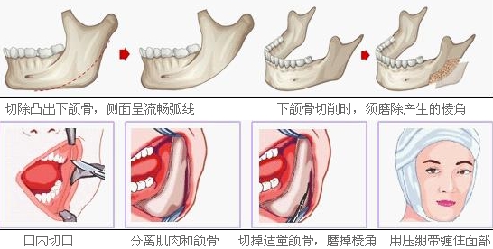 下颌角整形案例